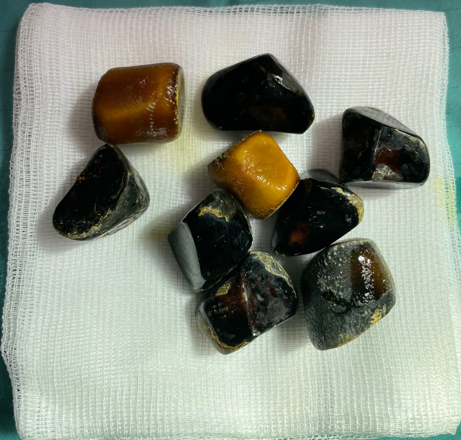 Colecisti e Colecistectomia